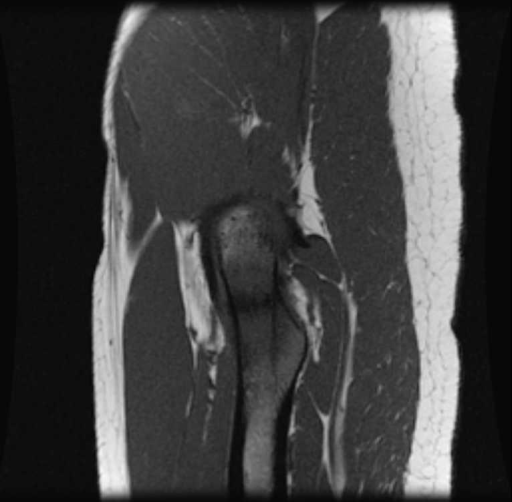 Stress fracture right femoral neck.