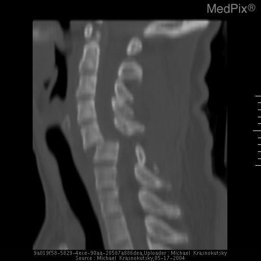 Bilateral jumped locked facets