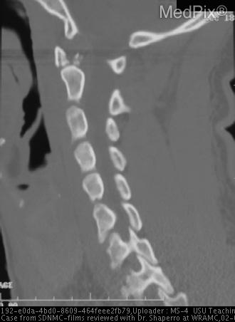 Multiple C1 fractures