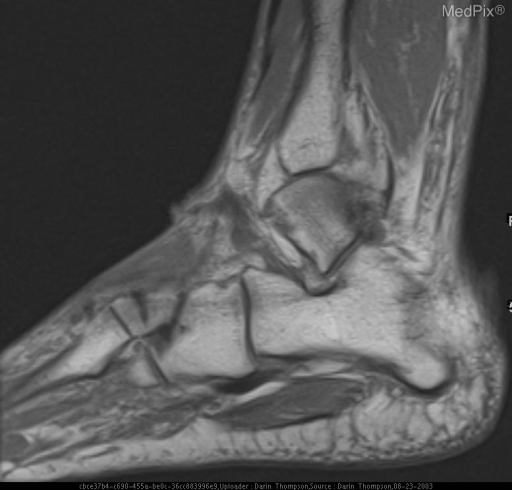 Cuneiform Stress Fracture