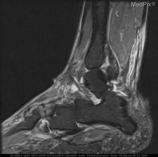 Cuneiform Stress Fracture