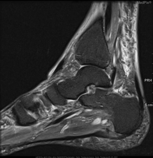 Cuneiform Stress Fracture