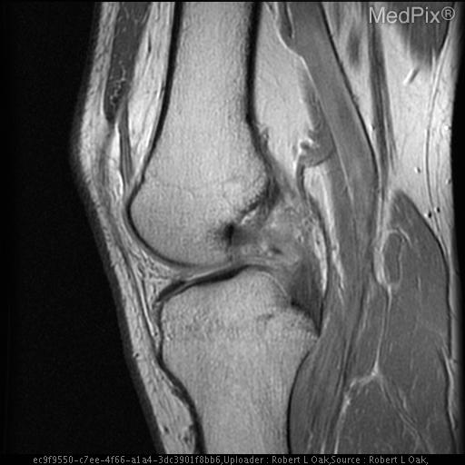 Isolated Posterior Cruciate Ligament Tear