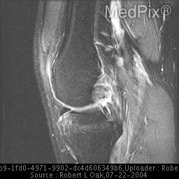Isolated Posterior Cruciate Ligament Tear